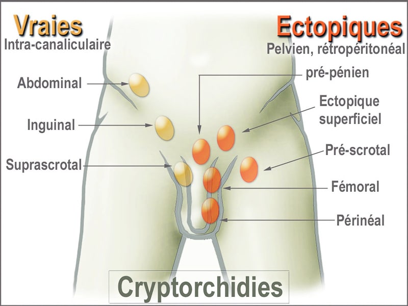 Ectopie testiculaire ou cryptorchidie